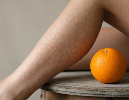 Cellulite gambe